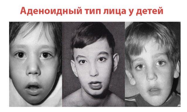 Аденоидный тип лица