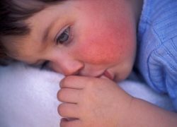 Инкубационный период скарлатины