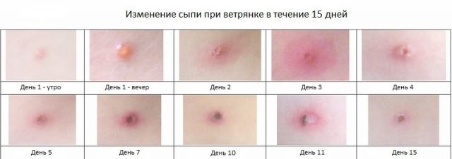 Развитие сыпи при ветрянке