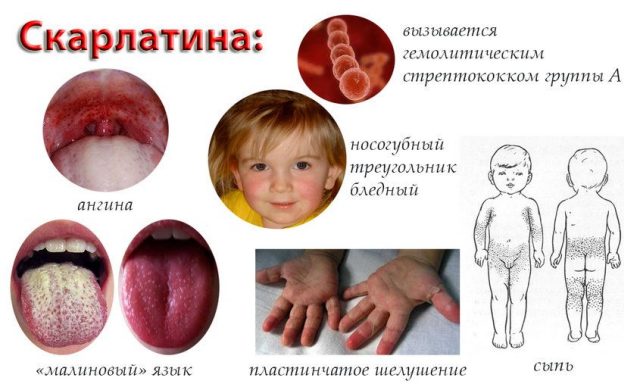 Симптомы скарлатины