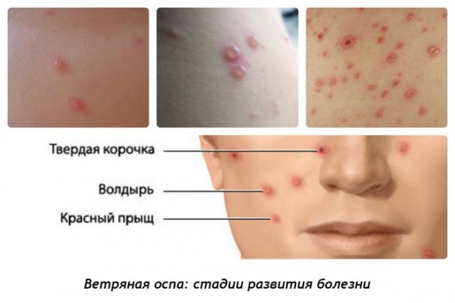 Стадии развития ветрянки