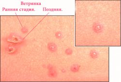 Стадии ветрянки