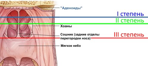 Степени воспаления аденоидов
