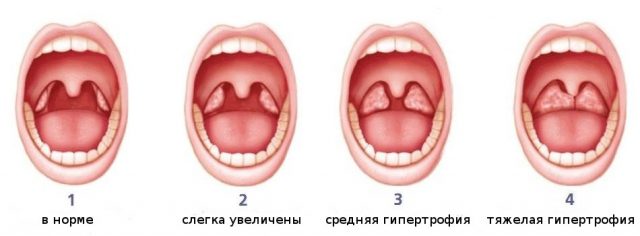 Степени аденоидов