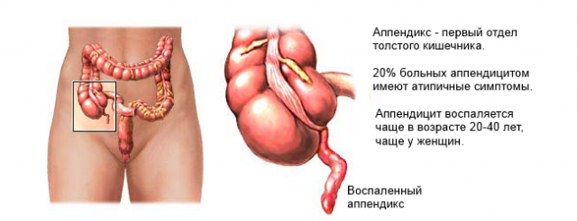 Аппендикс