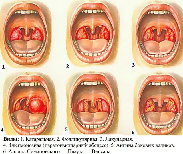 Формы ангины