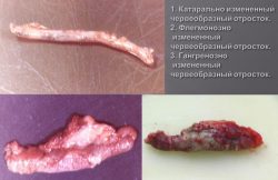 Фото аппендикса на различных стадиях