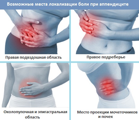 Место боли при аппендиците