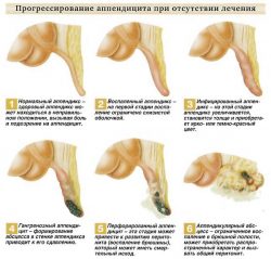 Прогрессирование аппендицита