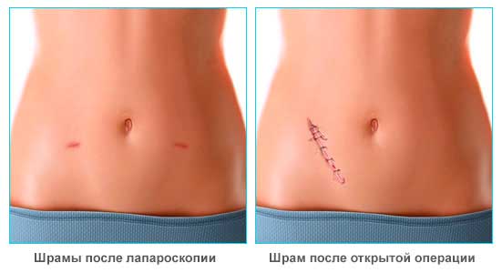 Шрамы после аппендицита