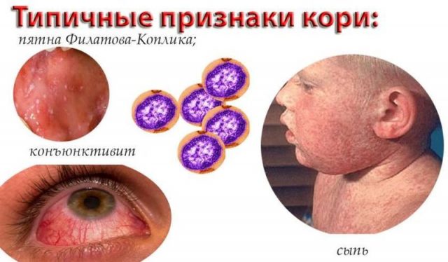 Симптомы кори