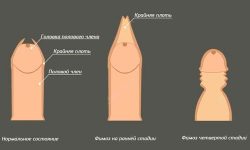 Фимоз - начальная и последняя стадии