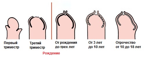 Физиологический фимоз