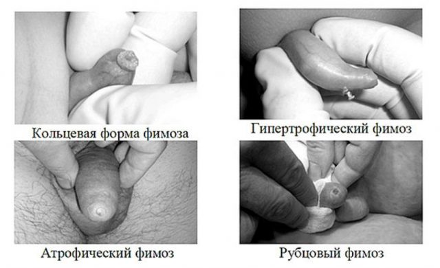 Формы фимоза