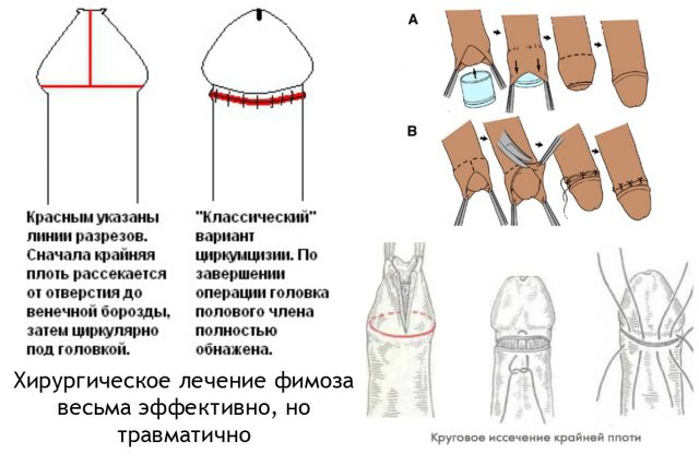 Хирургическое лечение фимоза