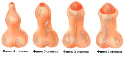 Степени фимоза
