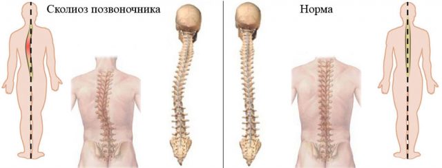 Сколиоз и норма