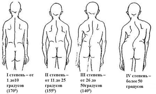 Степени сколиоза