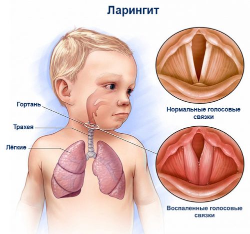 Ларингит у ребенка