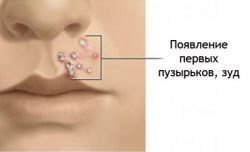 Начало стрептодермии