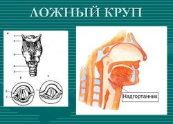 Ложный круп