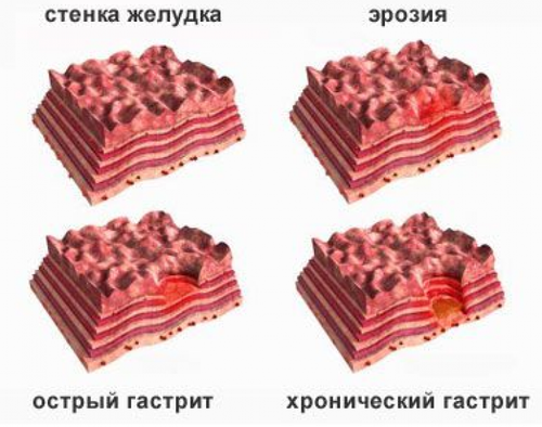 Стадии развития гастрита