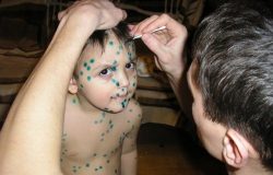 Чем снять зуд при ветрянке