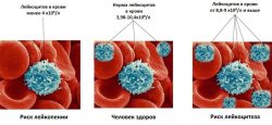 Повышены лейкоциты в крови
