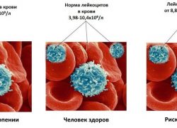 Повышены лейкоциты в крови