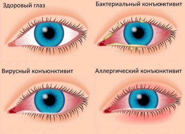виды конъюнктивита