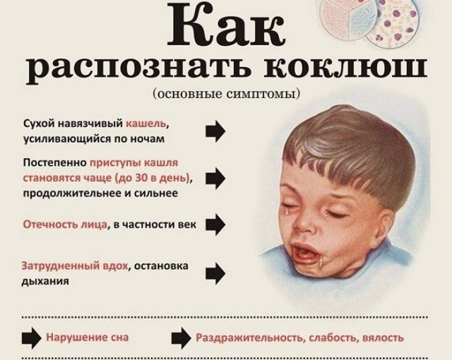 коклюш