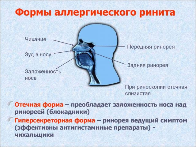 ринит