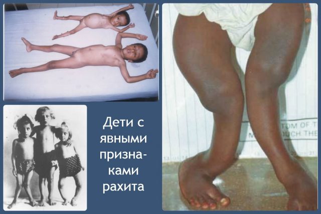 рахит
