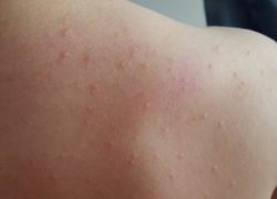 сыпь на спине ребенка