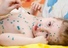 Миниатюра к статье Как и чем лечить ветрянку у детей правильно