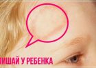 Миниатюра к статье Чем и как лечить лишай у детей