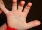 Миниатюра к статье Сыпь у ребенка на ладошках и ступнях в виде пузырьков